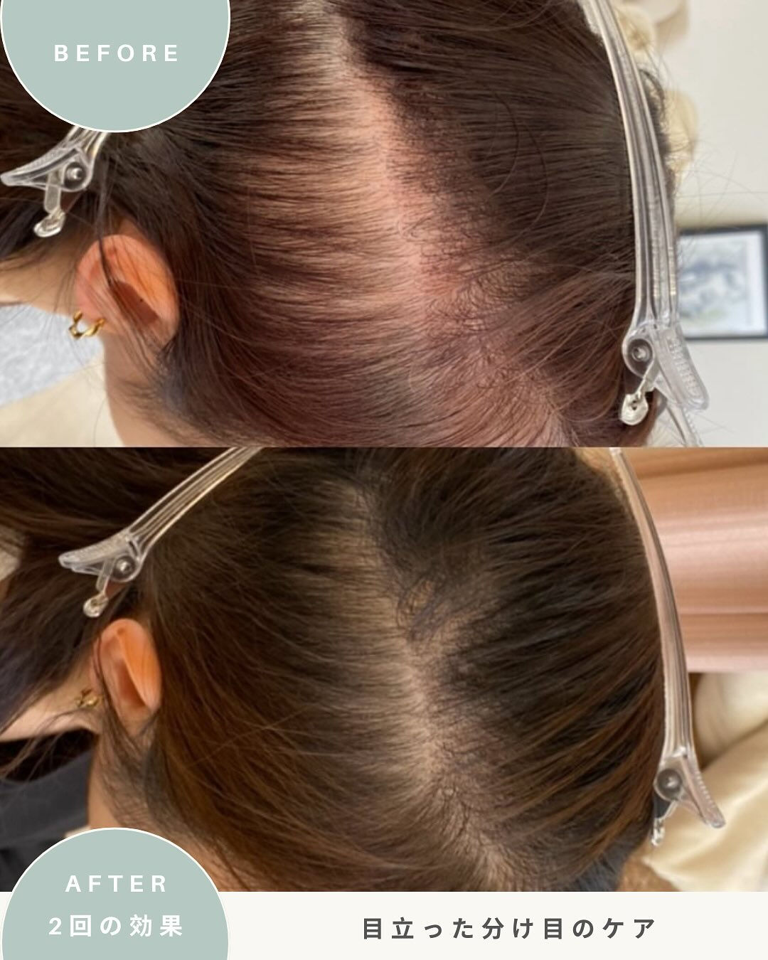 ＼女性の育毛ケア　症例写真／