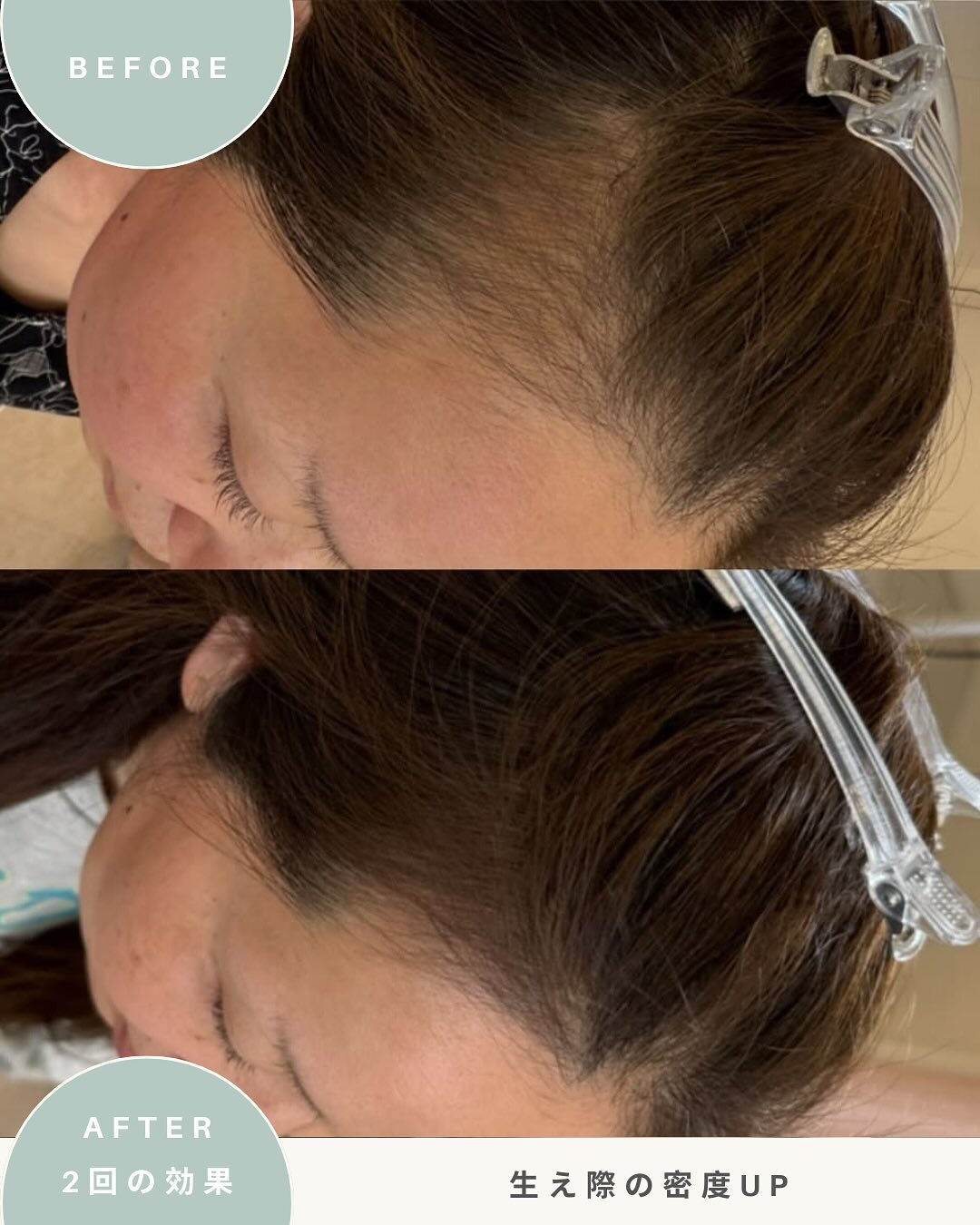 ＼女性の育毛ケア　症例写真／