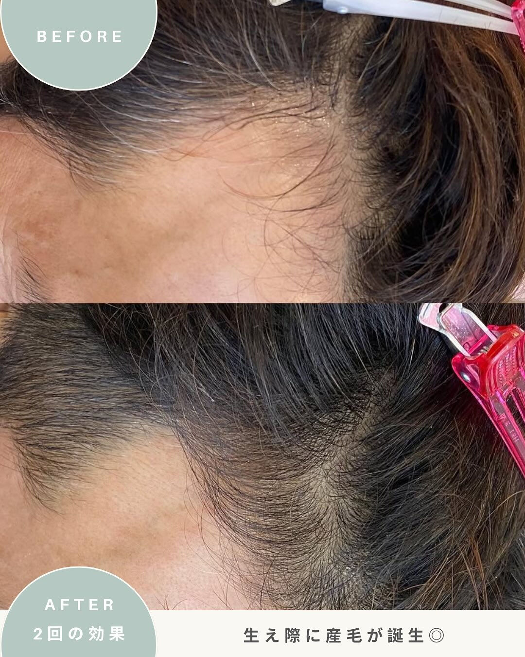＼男性の育毛ケア　症例写真／