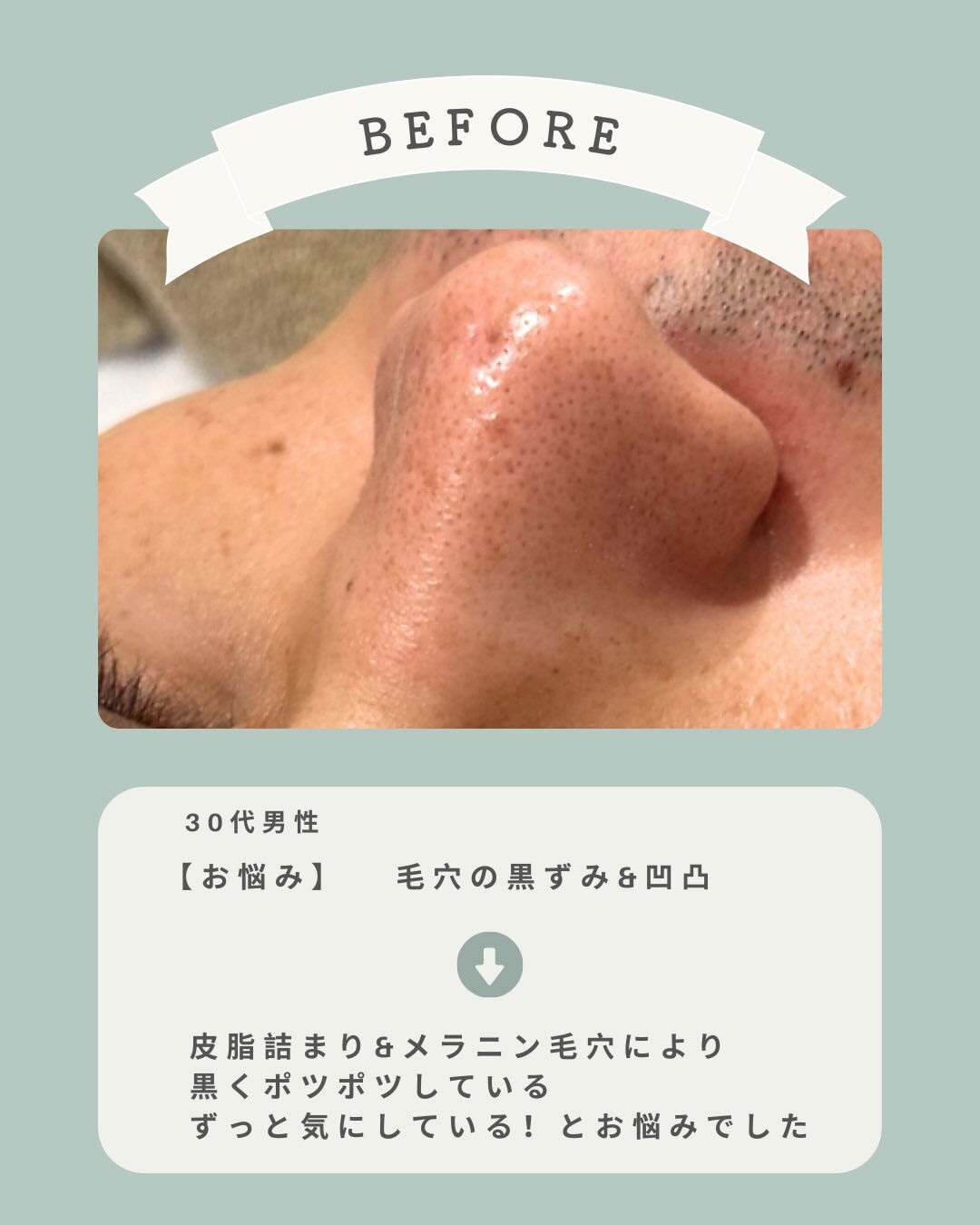 ＼手強い毛穴悩みにもアプローチ💪🏻✨／