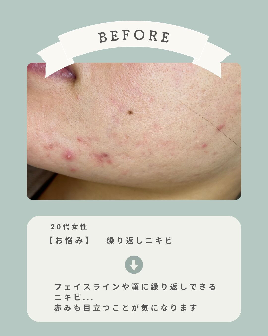 ‬- ̗̀ fon beautyの2度と悩まないニキビ改善♡