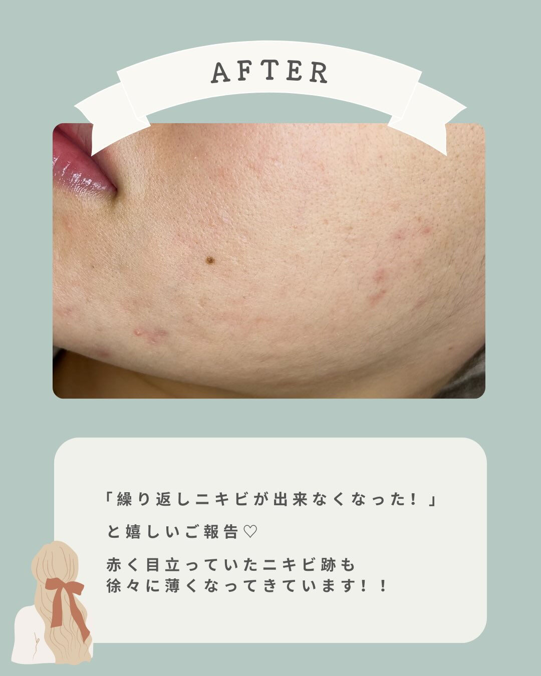 ‬- ̗̀ fon beautyの2度と悩まないニキビ改善♡
